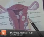 where the fibroids are located