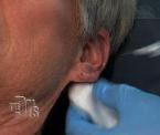 earlobe rejuvenation with filler injections