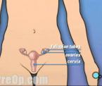 possible reasons for uterus removal surgery