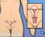 reasons for removal of uterus ovaries and fallopian tubes