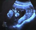 kelseys ultrasound on wake up call