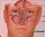 sinus infection balloon treatment