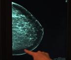 3d mammography aids in the fight against breast cancer