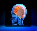 deep brain stimulation therapy for distonia