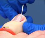 permanent ingrown toenail solution